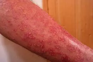 skin health psoriasis