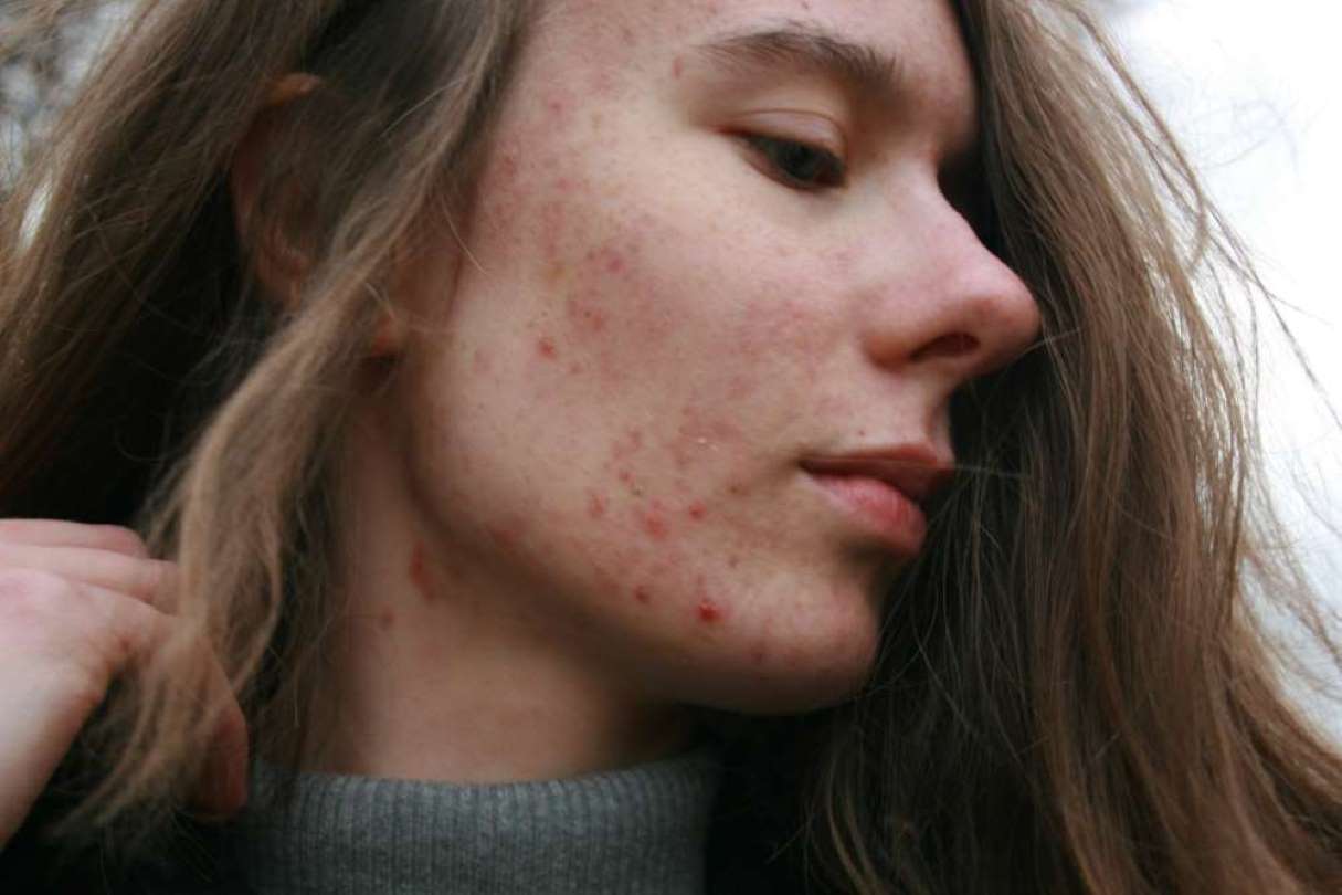 female with acne showing the side of her face